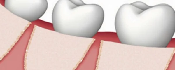 gelfoam-fell-out-after-tooth-extraction-is-it-a-problem