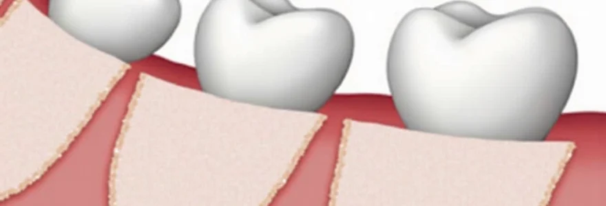 gelfoam-fell-out-after-tooth-extraction-is-it-a-problem